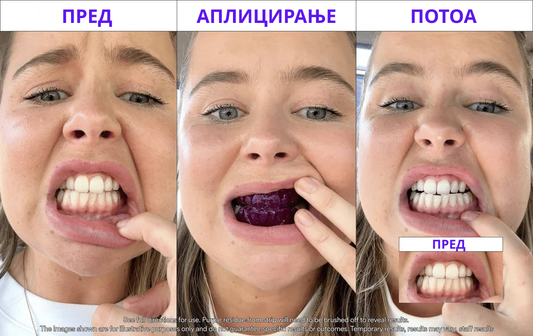 SMILE BUNDLE - ПАП+ Ленти за избелување и ГРАТИС V34 Ленти за избелување